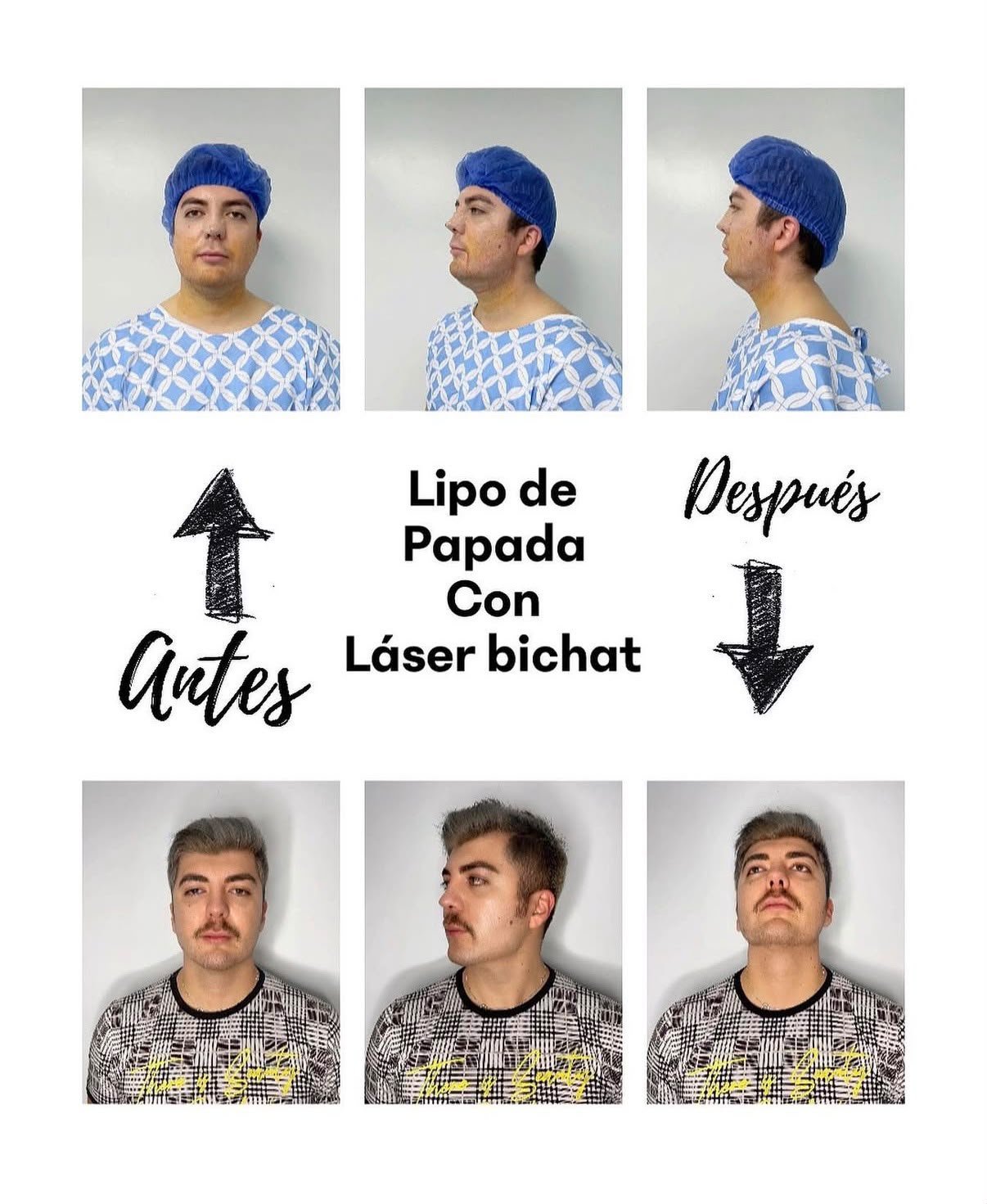 Antes y después de lipo de papada con láser, vista frontal y de perfil