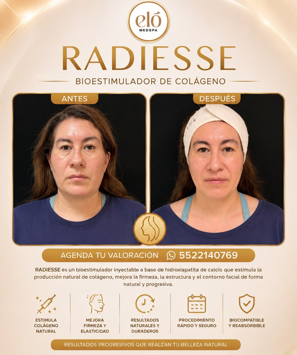 Antes y después de Radiesse, bioestimulador de colágeno
