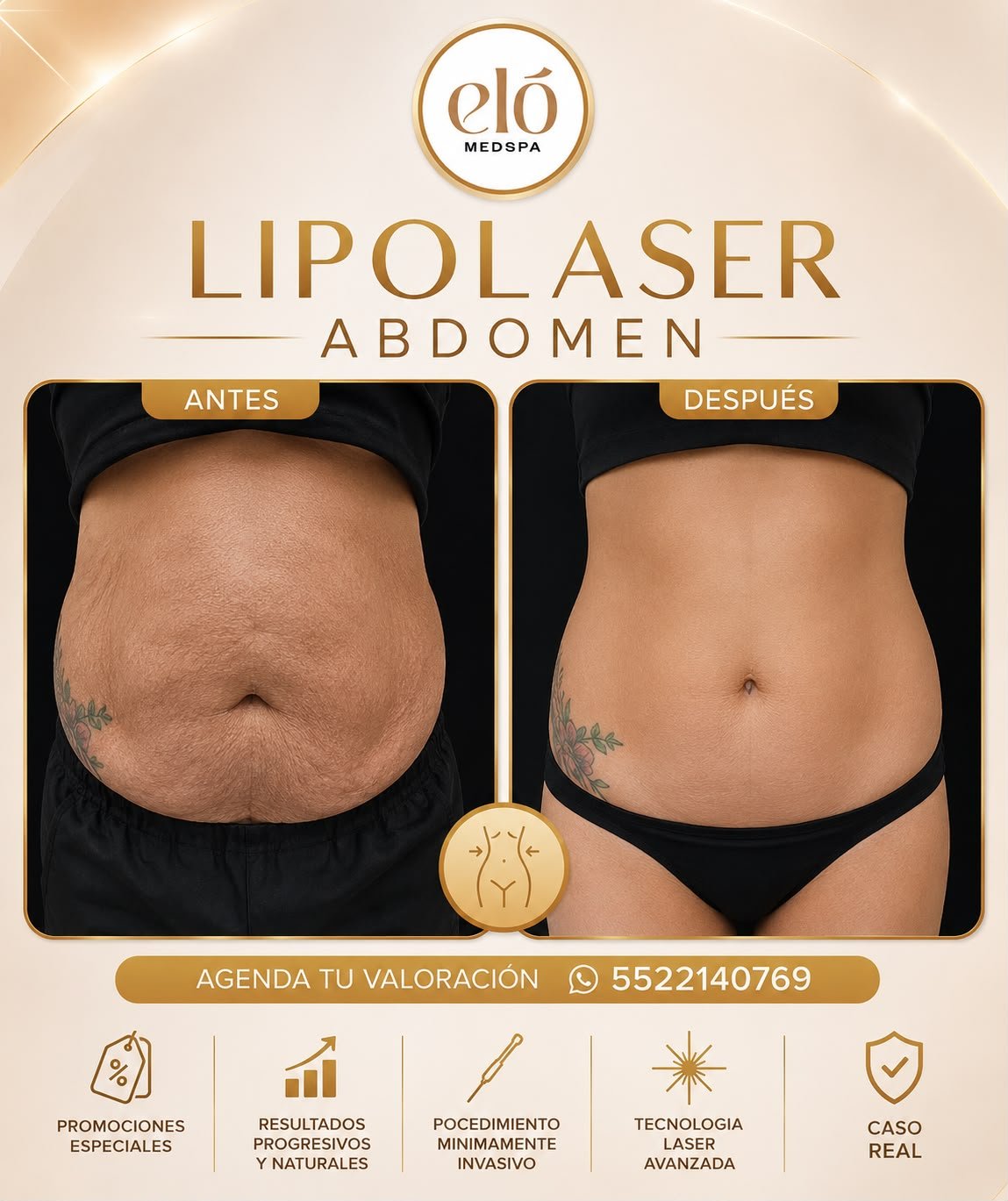 Antes y después de Lipolaser en abdomen